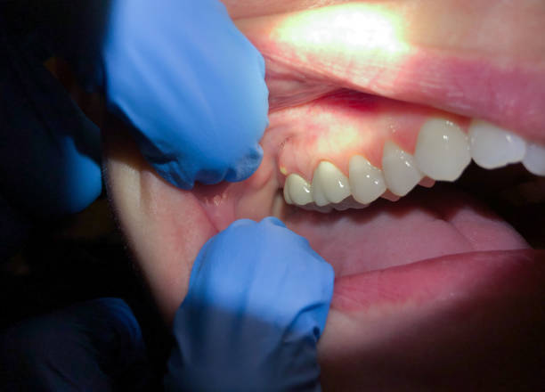 Best Cracked Tooth Emergency Dentist  in West Ocean City, MD